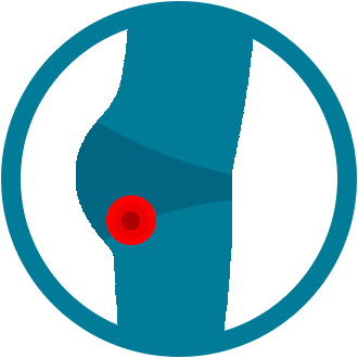 Síndrome do Piriforme