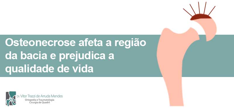 A osteonecrose ou necrose na cabeça femoral é um problema que ataca a cabeça do fêmur, provocando dores ao se movimentar na nádega ou virilha.