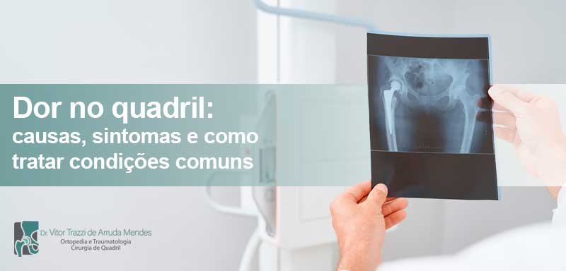 A dor no quadril é um problema que afeta pessoas de todas as idades, e pode ser causada por diversas condições, como artrite, artrose, bursite, tendinite, necrose, fratura subcondral, lesão no lábio acetabular e impacto femoroacetabular (IFA). Compreender as causas é fundamental para o tratamento adequado e a prevenção de complicações. Neste artigo, Dr. Vitor Trazzi de Arruda Mendes, especialista em cirurgia do quadril, explica as principais causas de dor no quadril e os melhores tratamentos.