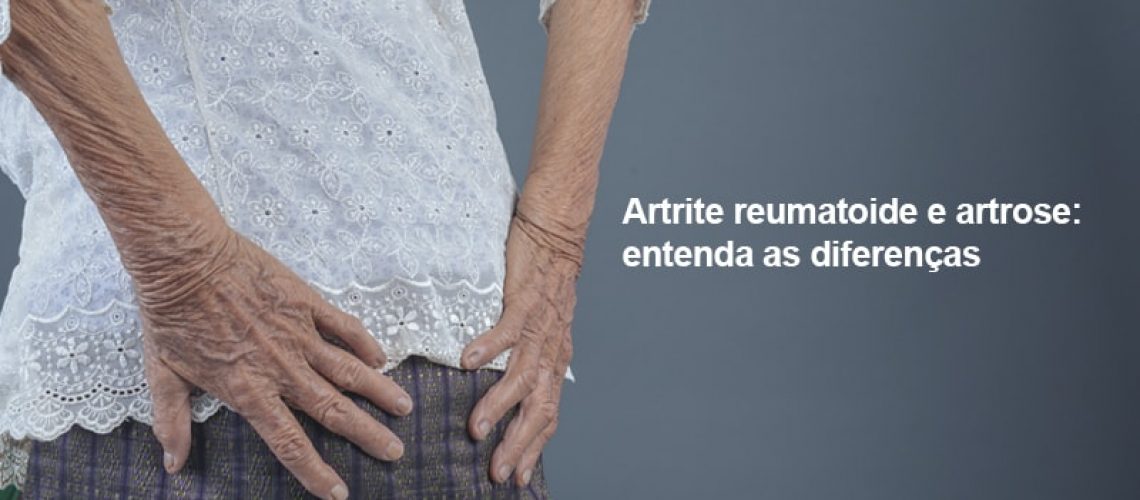 Artrite reumatoide e artrose podem levar à incapacidade funcional dos pacientes. Entenda as diferenças e os sintomas destas afecções articulares.