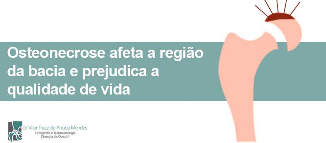 A osteonecrose ou necrose na cabeça femoral é um problema que ataca a cabeça do fêmur, provocando dores ao se movimentar na nádega ou virilha.